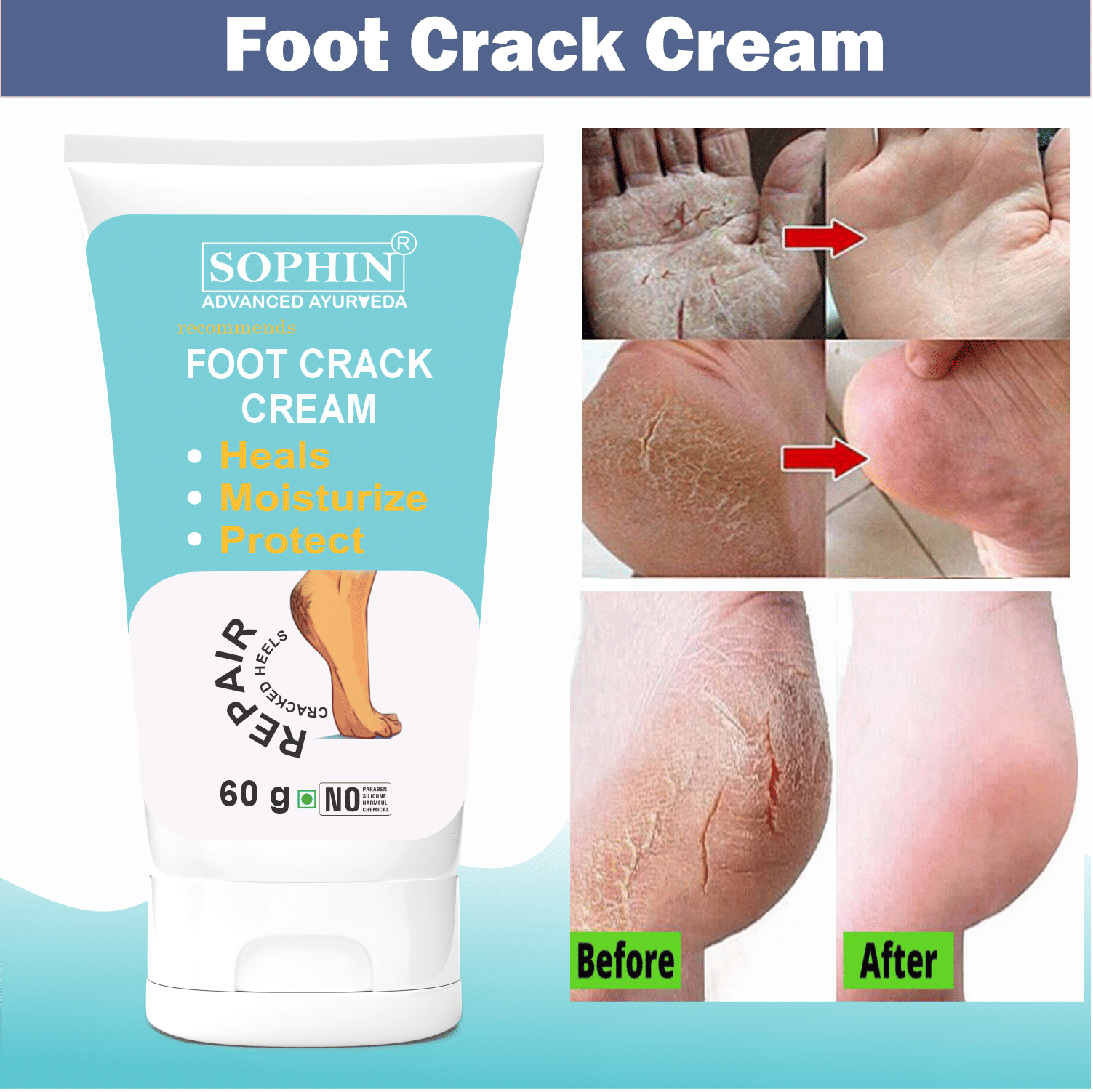 SOPHIN Cracked skin repair Cream for All year ( 60 g )