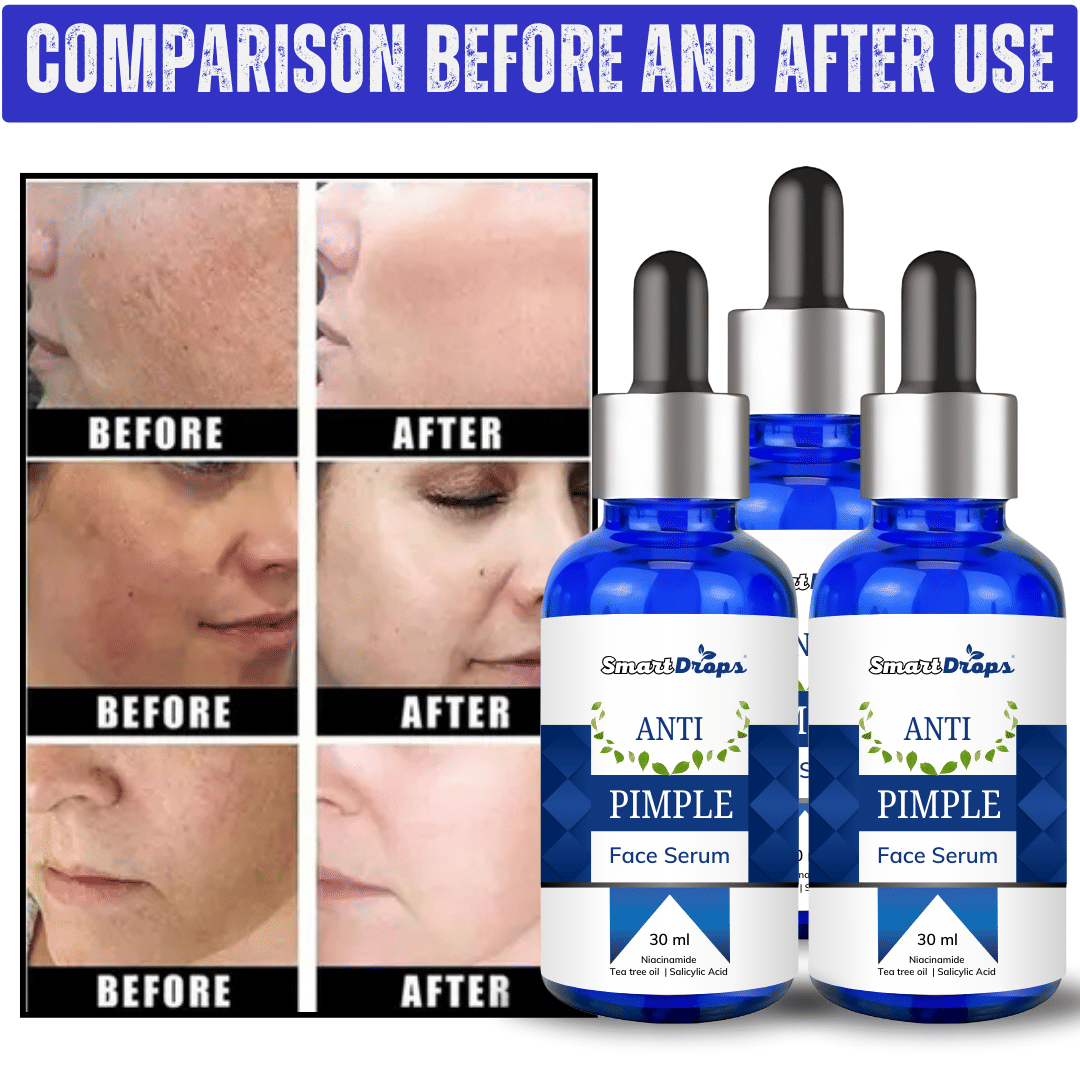 Smartdrops Face Serum Tea Tree Blemishes Removal For Normal Skin ( Pack of 3 ) Smartdrops Face Serum Tea Tree Blemishes Removal For Normal Skin ( Pack of 3 )