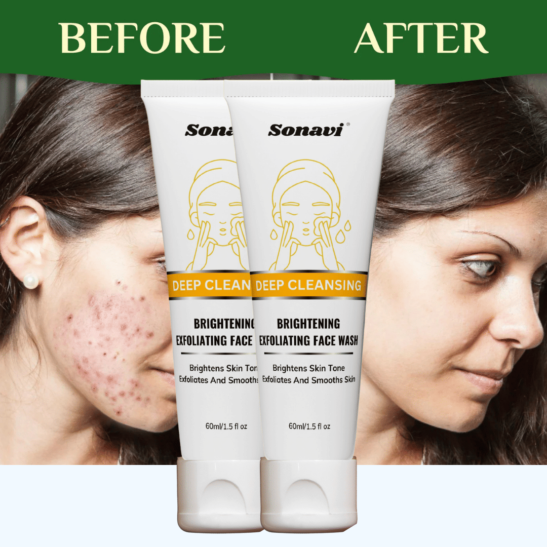 Sonavi - Acne or Blemishes Removal Face Wash For All Skin Type ( Pack of 2 )     			Sonavi - Acne or Blemishes Removal Face Wash For All Skin Type ( Pack of 2 )