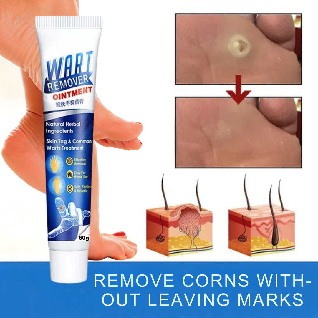 Wart Removal Ointment Treatment for Remove Warts Moles & Acne Safely Painless