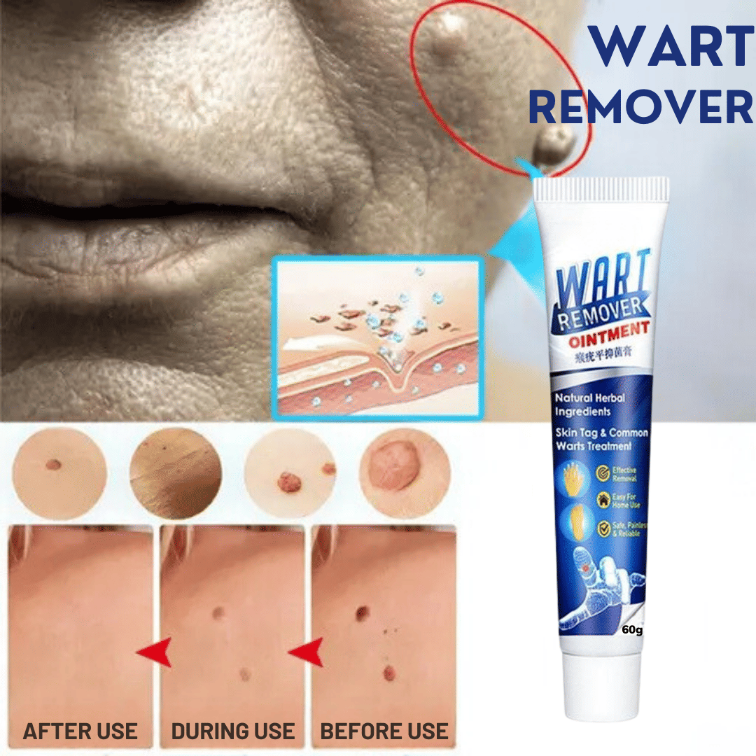Wart Removal Ointment Treatment for Remove Warts Moles & Acne Safely Painless