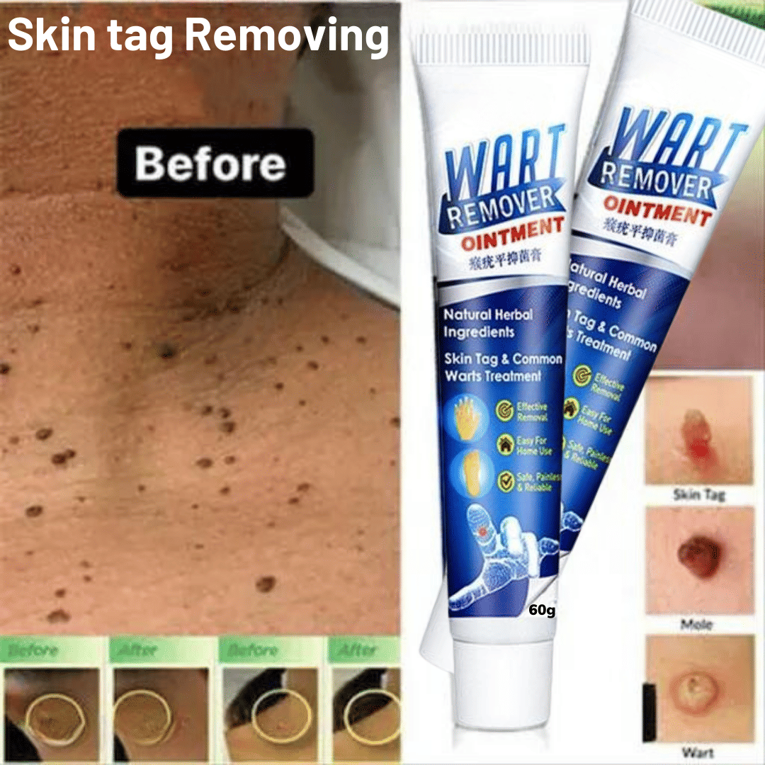 Wart Removal Ointment Treatment for Remove Warts Moles & Acne Safely Painless