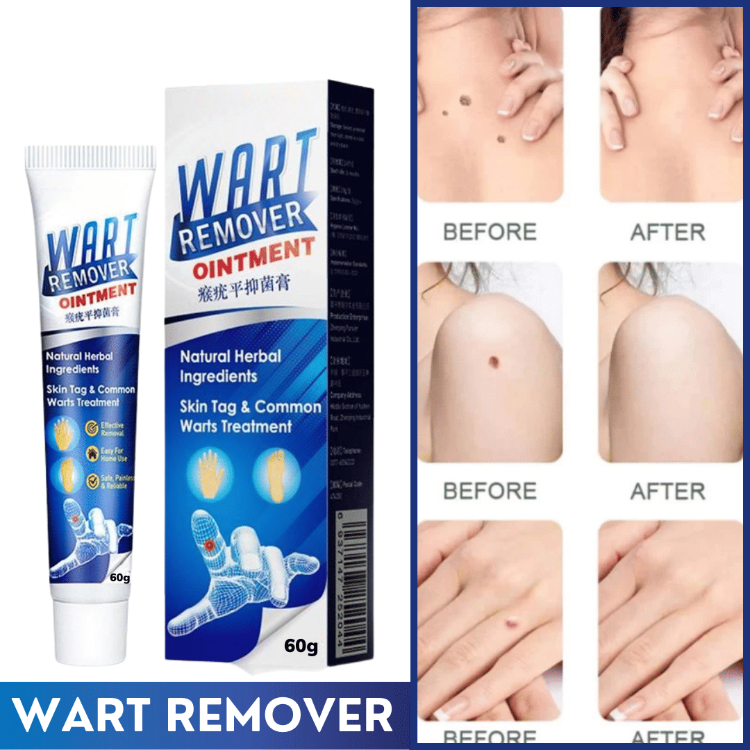 Wart Remover Cream For Blackhead remover, Pimple remover, Dead skin remover  Cream