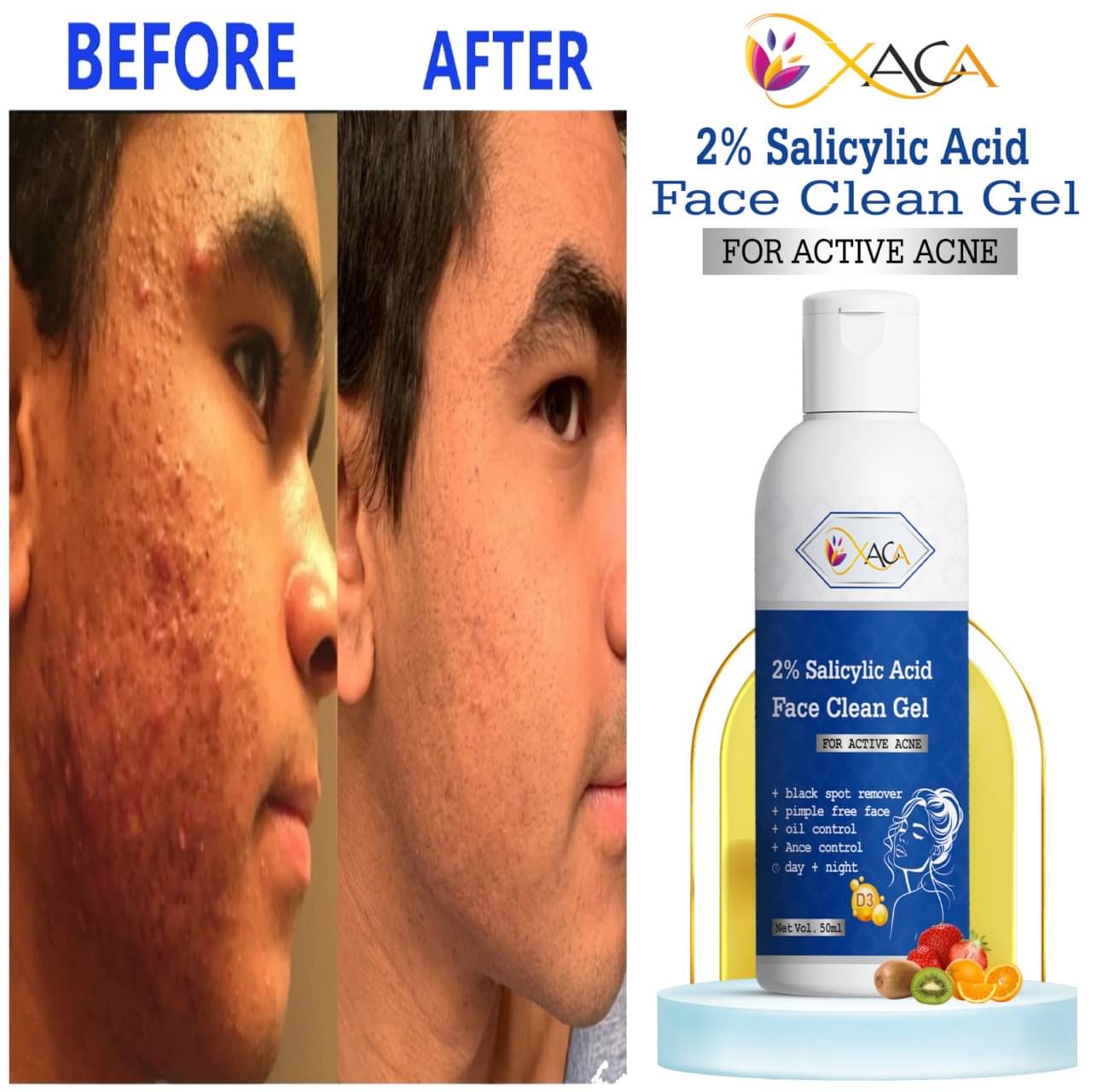 xaca Face Serum Salicylic Acid Acne Removal For All Skin Type ( Pack of 1 )     			xaca Face Serum Salicylic Acid Acne Removal For All Skin Type ( Pack of 1 )
