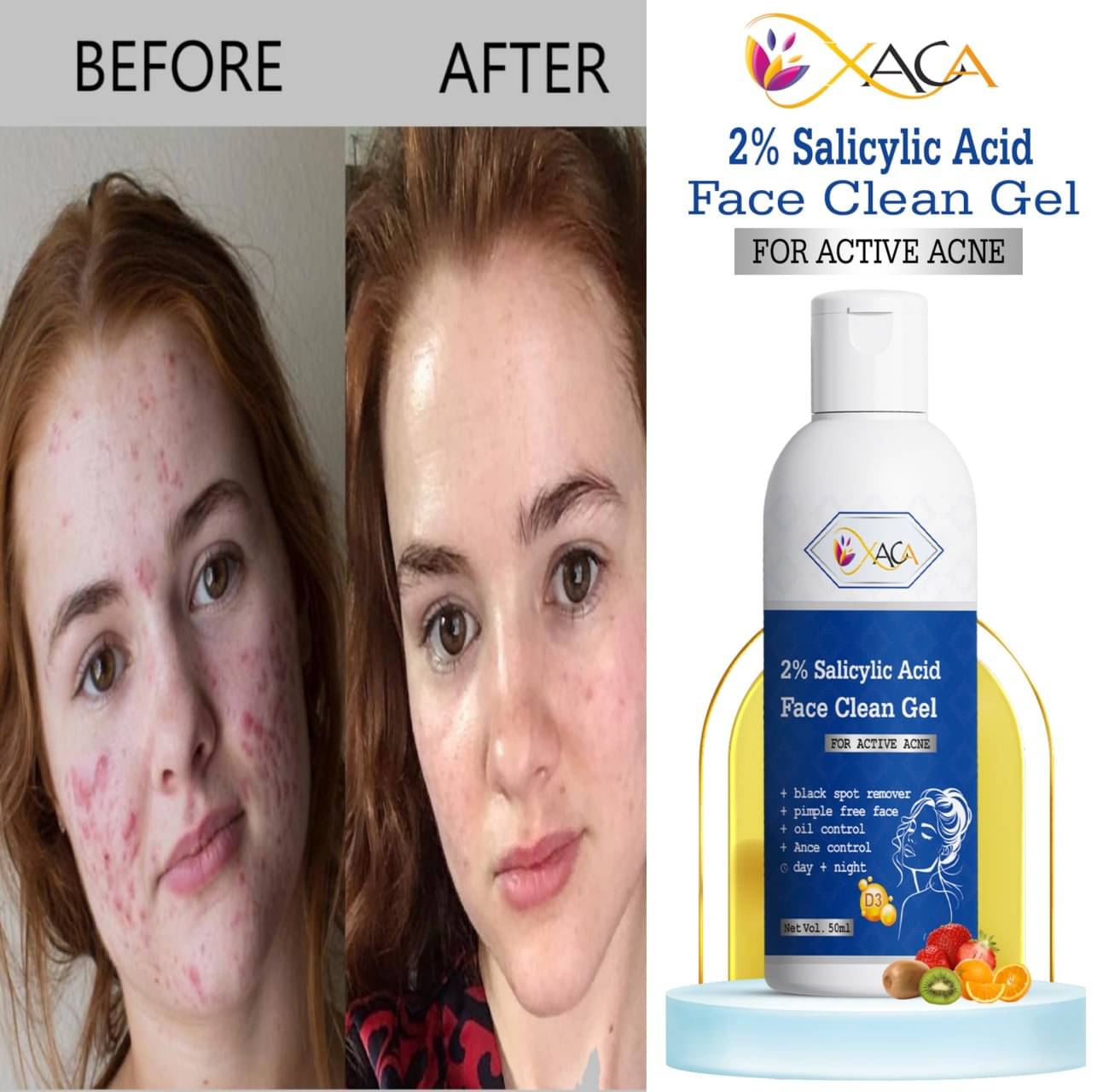 xaca Face Serum Salicylic Acid Acne Removal For All Skin Type ( Pack of 1 )     			xaca Face Serum Salicylic Acid Acne Removal For All Skin Type ( Pack of 1 )