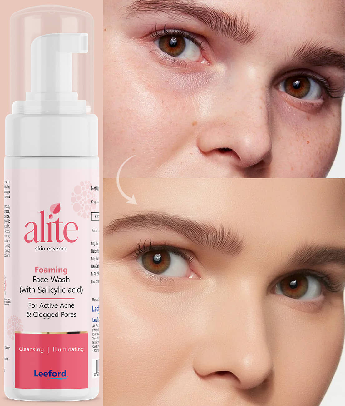 Alite - Acne or Blemishes Removal Face Wash For All Skin Type ( Pack of 1 )