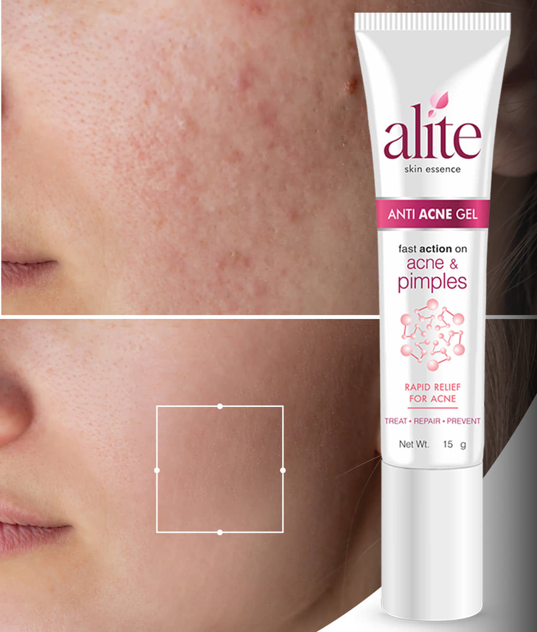 Alite Night Cream All Skin Type Tea Tree ( 15 gm )