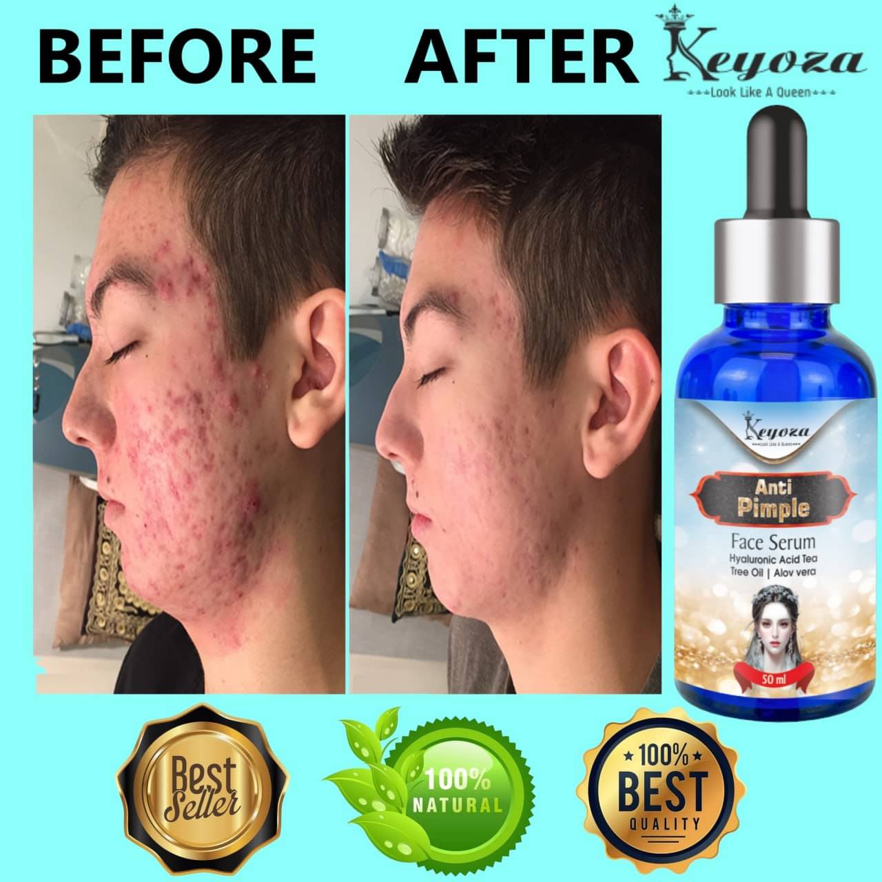 Keyoza Face Serum Hyaluronic Acid Spot Removal For All Skin Type ( Pack of 1 ) Keyoza Face Serum Hyaluronic Acid Spot Removal For All Skin Type ( Pack of 1 )