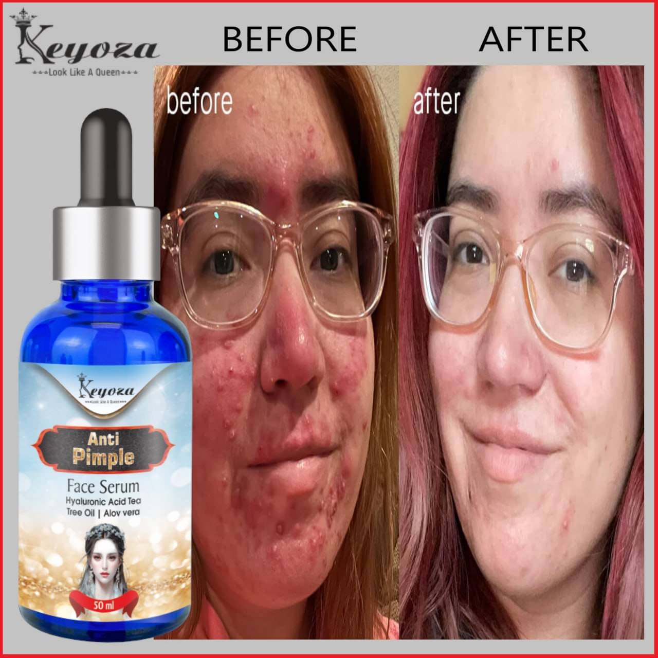     			Keyoza Face Serum Hyaluronic Acid Spot Removal For All Skin Type ( Pack of 1 )