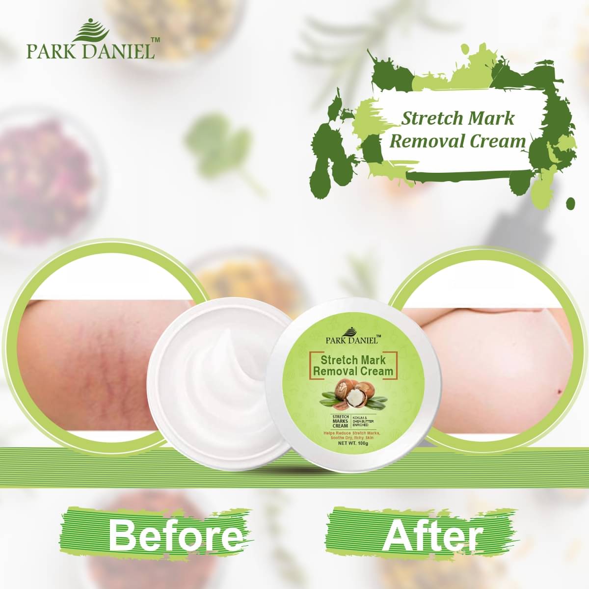     			Park Daniel Strecth Marks Removal Cream After Weight Loss and Pregnancy Pack of 1 of 100 Grams