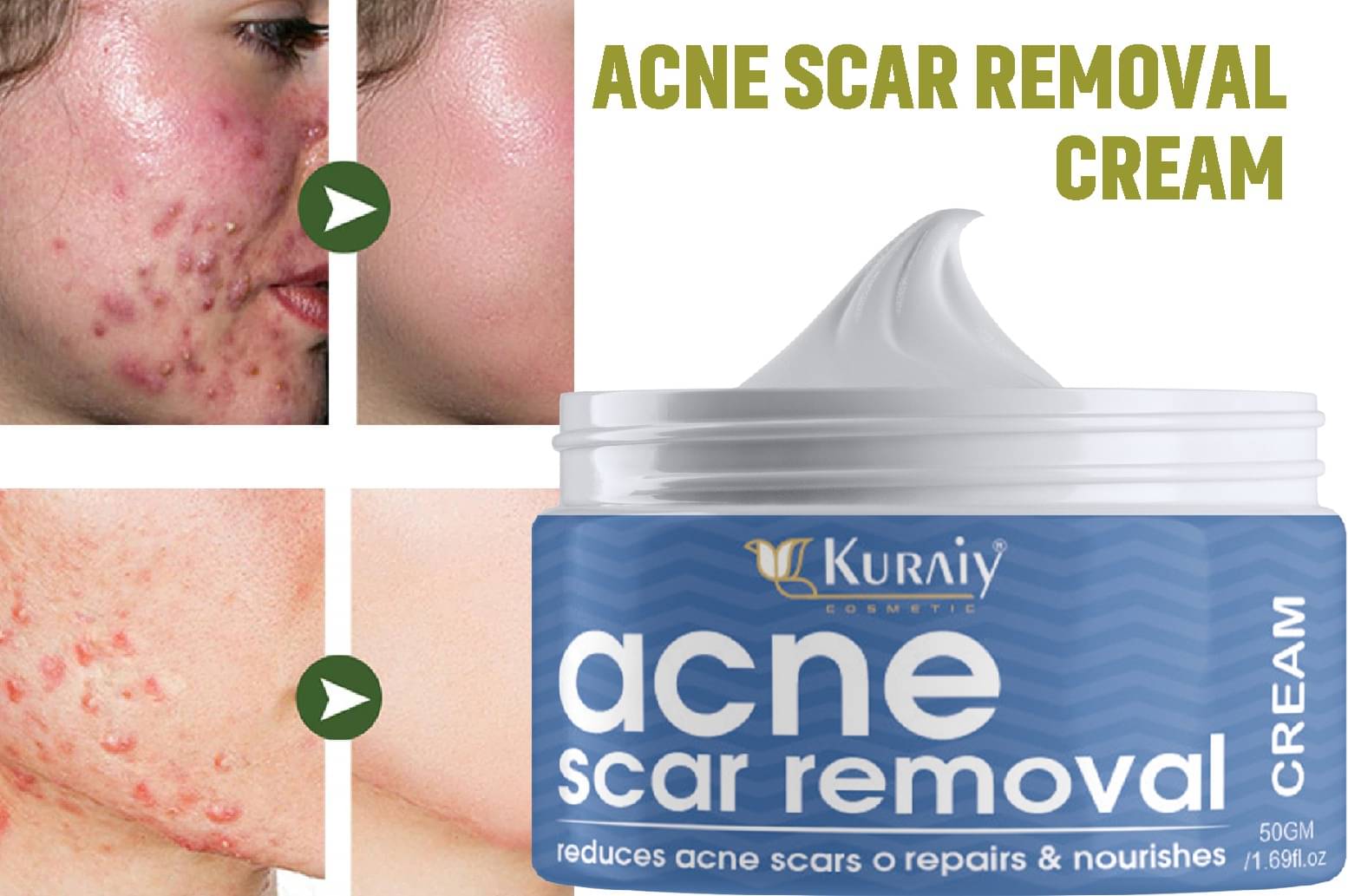KURAIY Acne Face Cream Herbal Pimple Scar Removal Shrink Pore Oil Control Facial Cream     			KURAIY Acne Face Cream Herbal Pimple Scar Removal Shrink Pore Oil Control Facial Cream