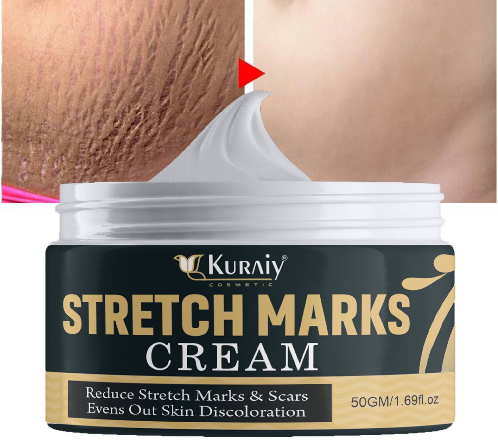     			KURAIY Remove Pregnancy Mark Body Cream Treatment Scars Acne Stretch Marks Cream