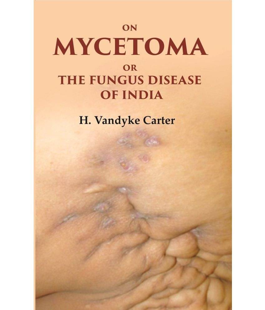 On Mycetoma or the Fungus Disease of India On Mycetoma or the Fungus Disease of India