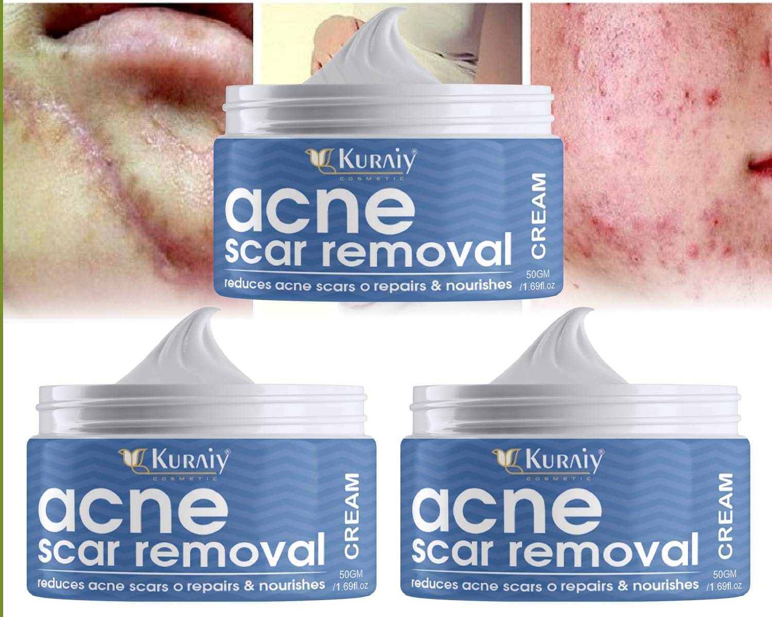     			KURAIY Scar Removal Cream Gel Remove Acne Spots Treatment Pack of 3