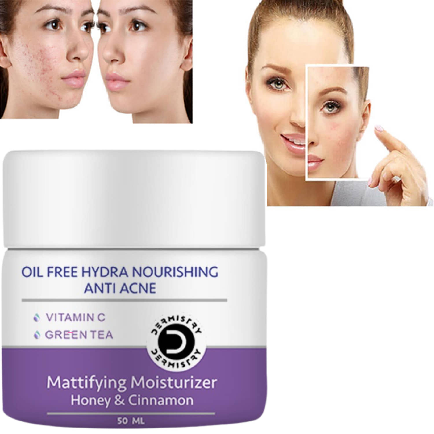 Vigini Anti Acne Vitamin C Oil Free Hydra Nourishing Mattifying Moisturizer Pimples Scar Removal Honey Cinnamon Salicylic Acid Niacinamide Face Gel For Men Women Acne Prone Skin, Removes Pigmentation Pore Tightening Use Cream Facial Kit Pack Serum Wash