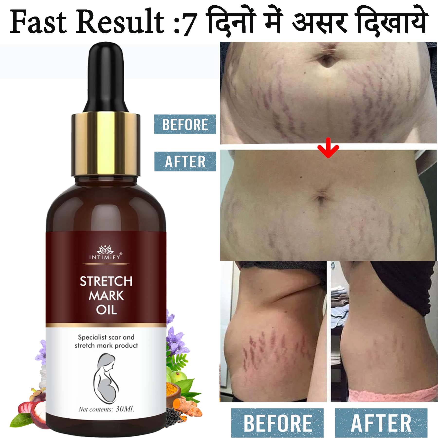     			Intimify Stretch Mark Oil, Stretch Mark Remover, Anti Cellulite Oil, Shaping & Firming Oil, 30 mL