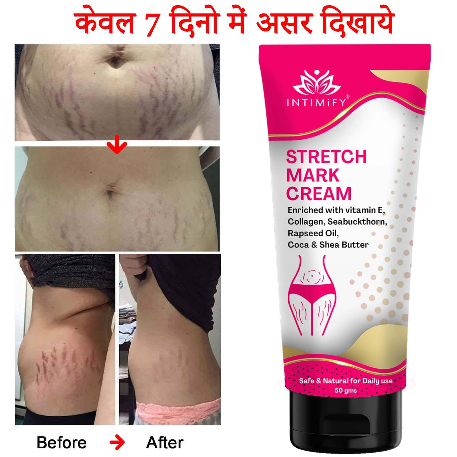     			Intimify Stretch Mark Remover Cream, Stretch Mark Cream, Shaping & Firming Cream 50 gms