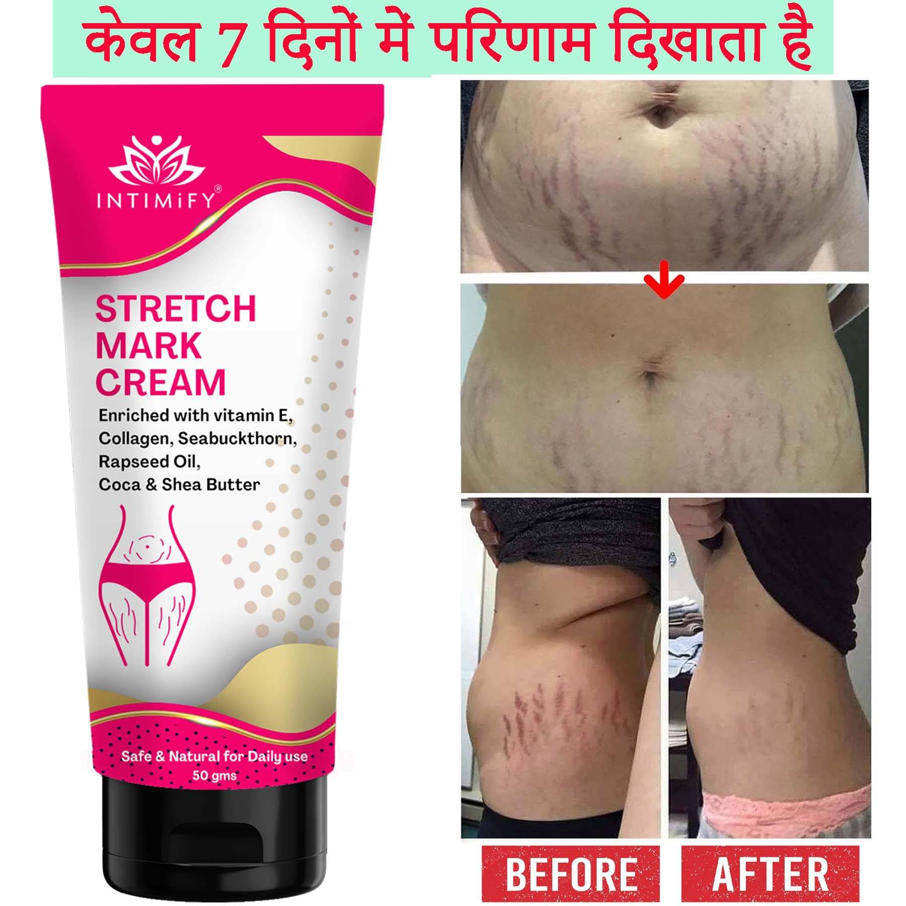     			Intimify Stretch Mark Cream, Stretch Mark Remover Cream, Shaping & Firming Cream 50 gms