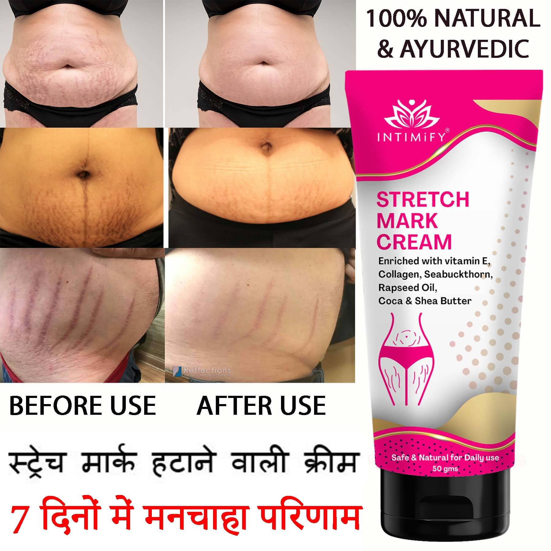     			Intimify Stretch Mark Cream, Stretch Mark Remover Cream, Shaping & Firming Cream 50 gms