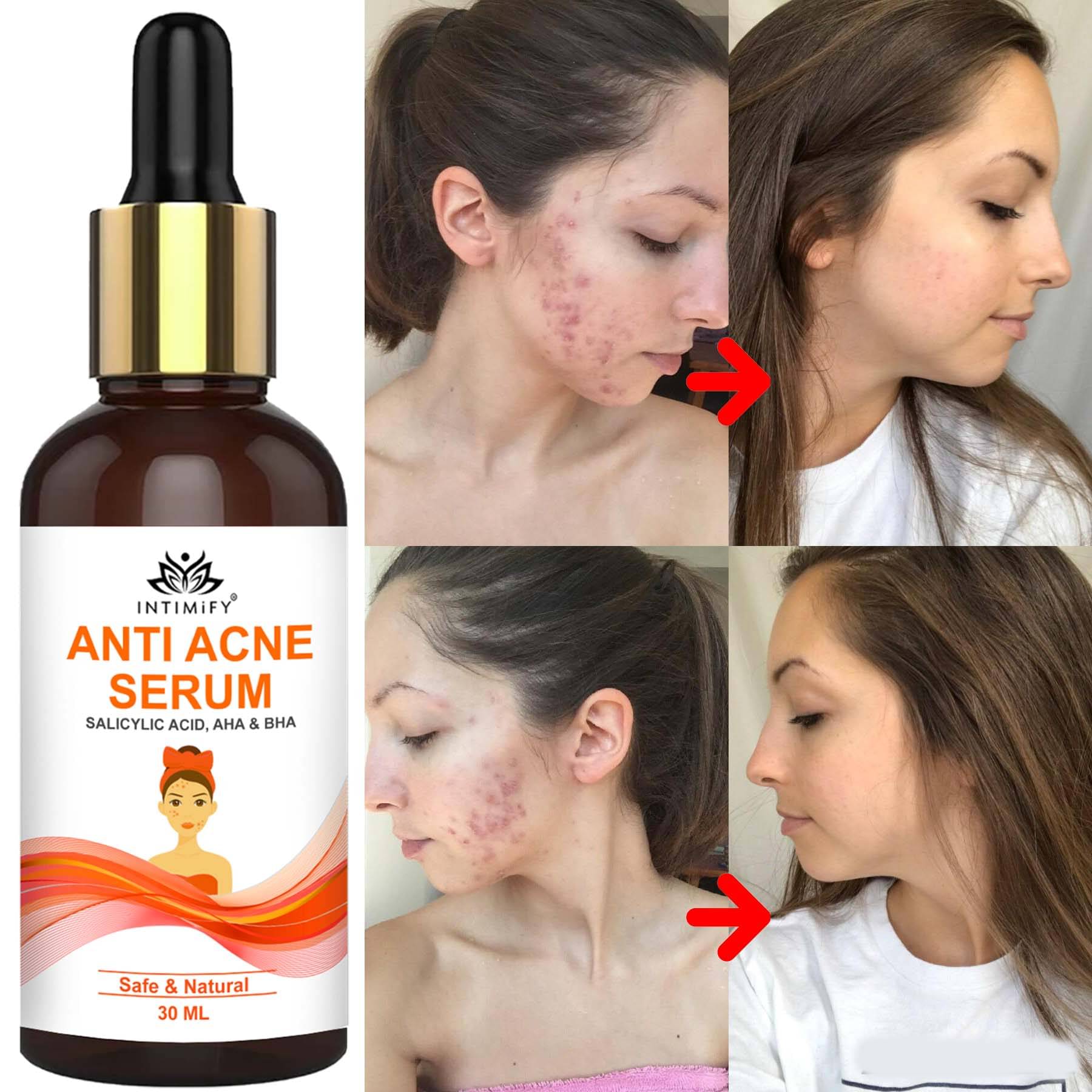 Intimify Anti Acne Face Serum, Anti Ageing, Skin Brightening, Acne Removal, 30 Ml Intimify Anti Acne Face Serum, Anti Ageing, Skin Brightening, Acne Removal, 30 Ml
