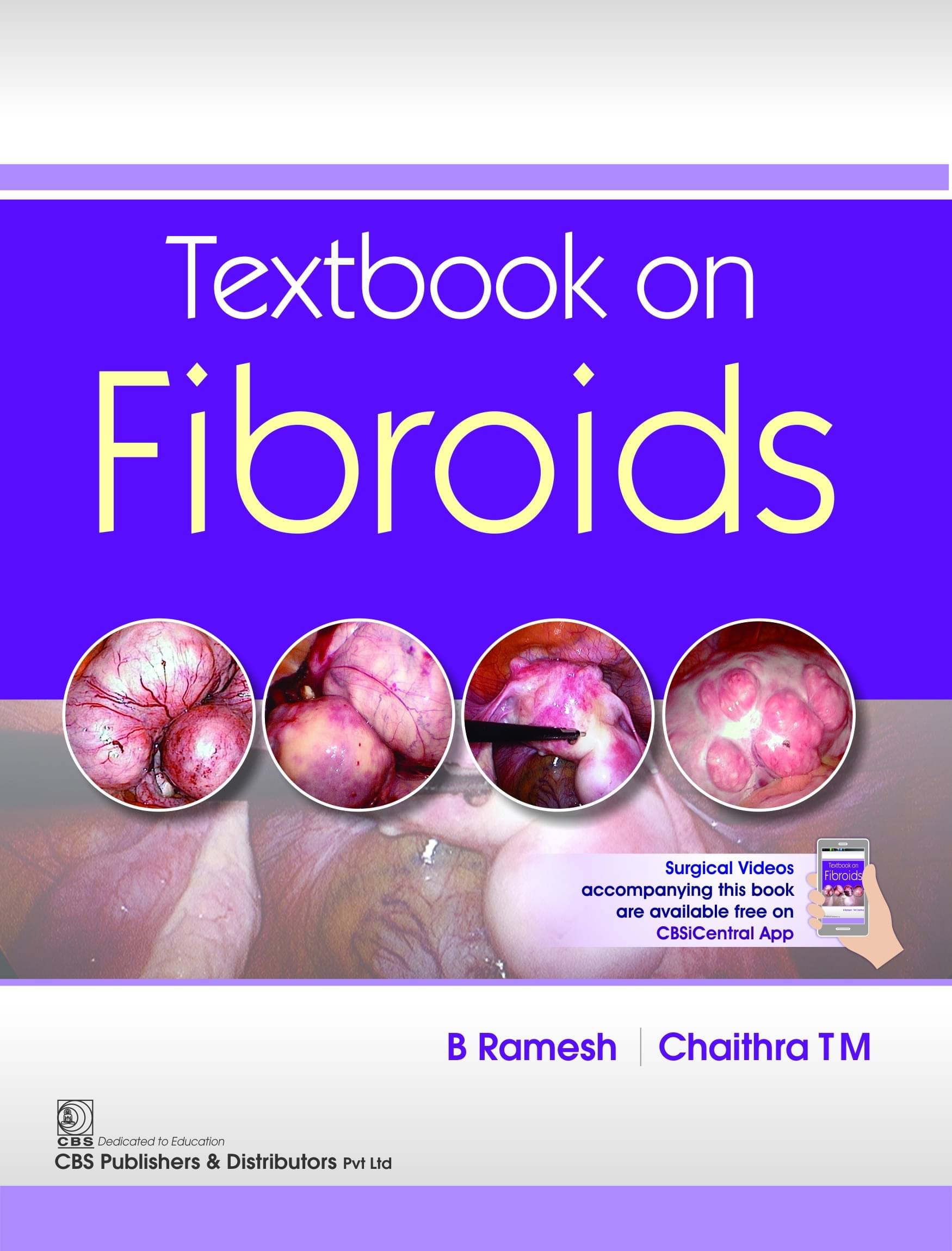Textbook on Fibroids Textbook on Fibroids