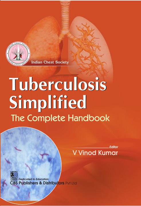 Tuberculosis Simplified: The complete Handbook Tuberculosis Simplified: The complete Handbook