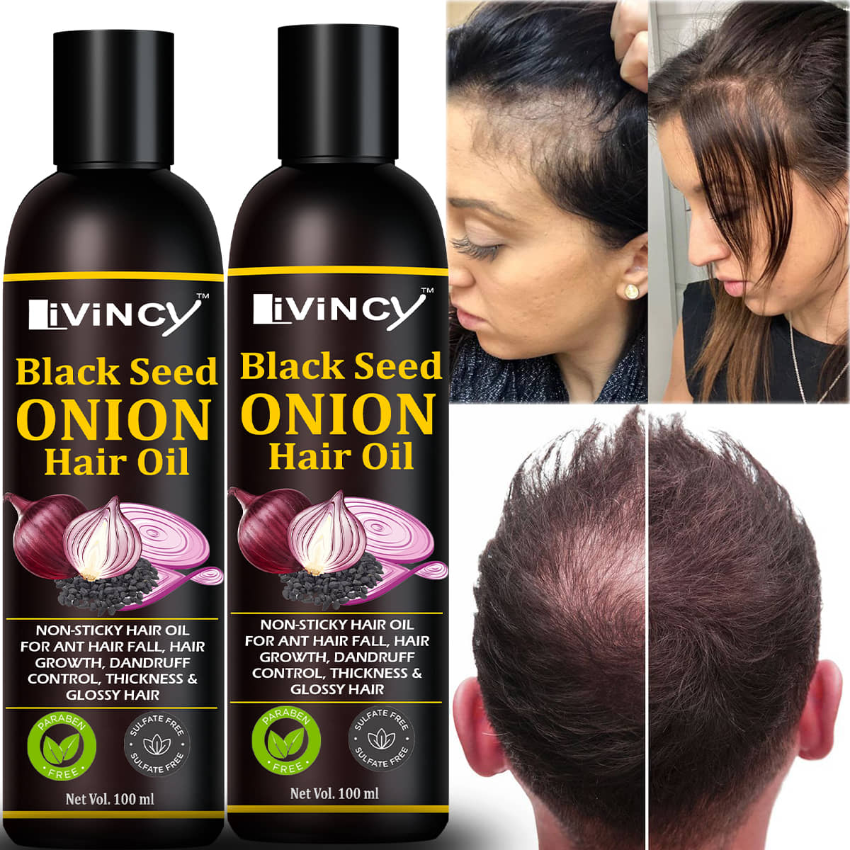 LIVINCY Hair Growth Onion Oil 200 ml ( Pack of 2 )