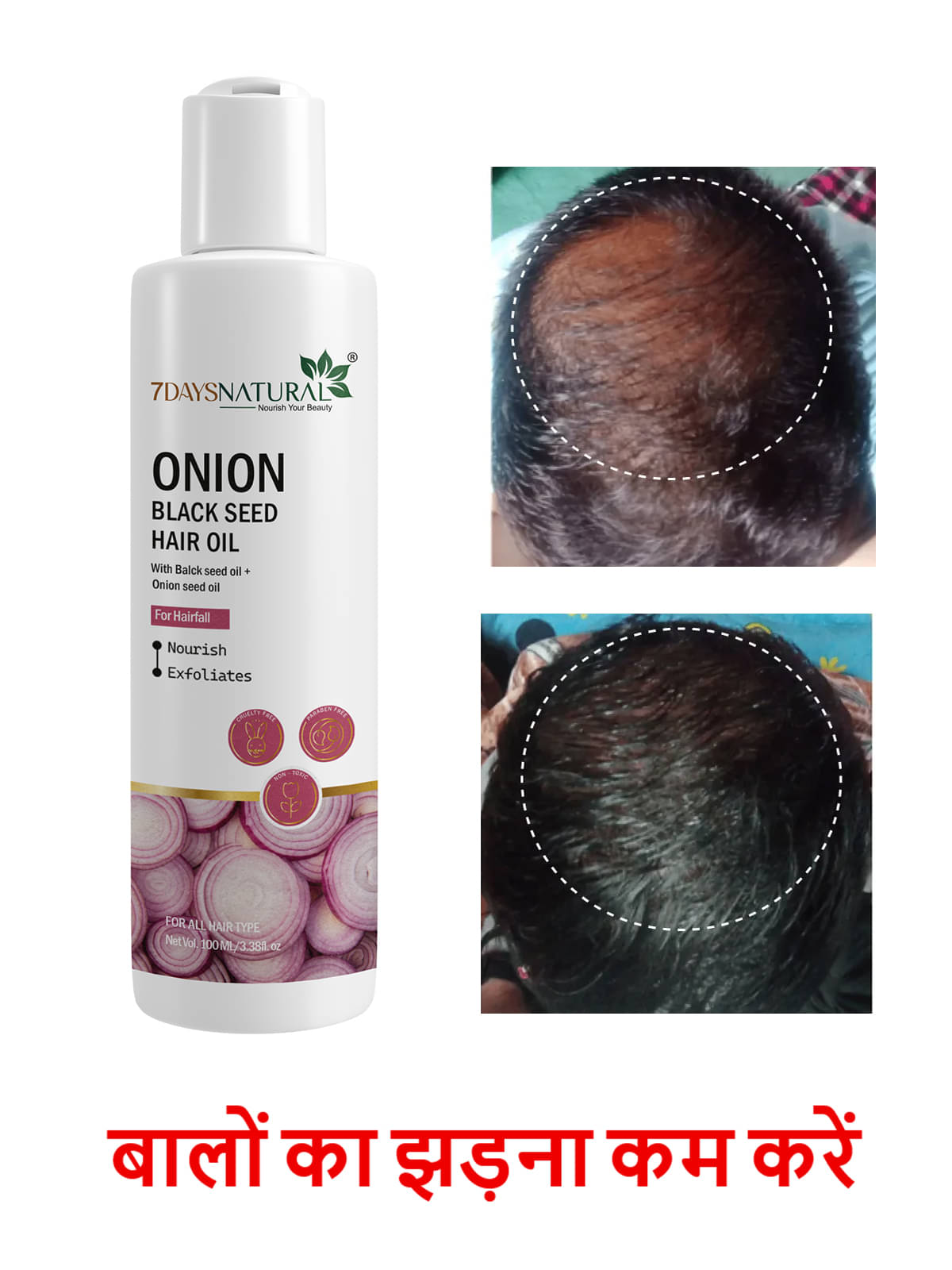    			7 days Hair Growth Onion Oil 100 ml ( Pack of 1 )