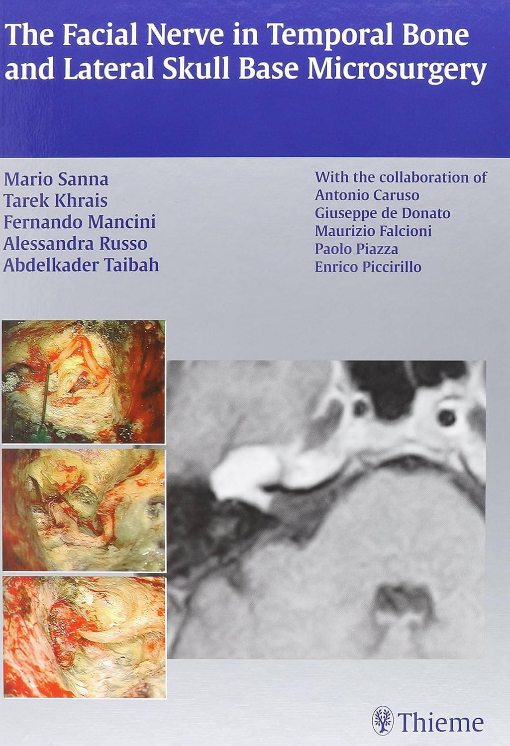     			Facial Nerve in Temporal Bone and Lateral Skull Base Microsurgery